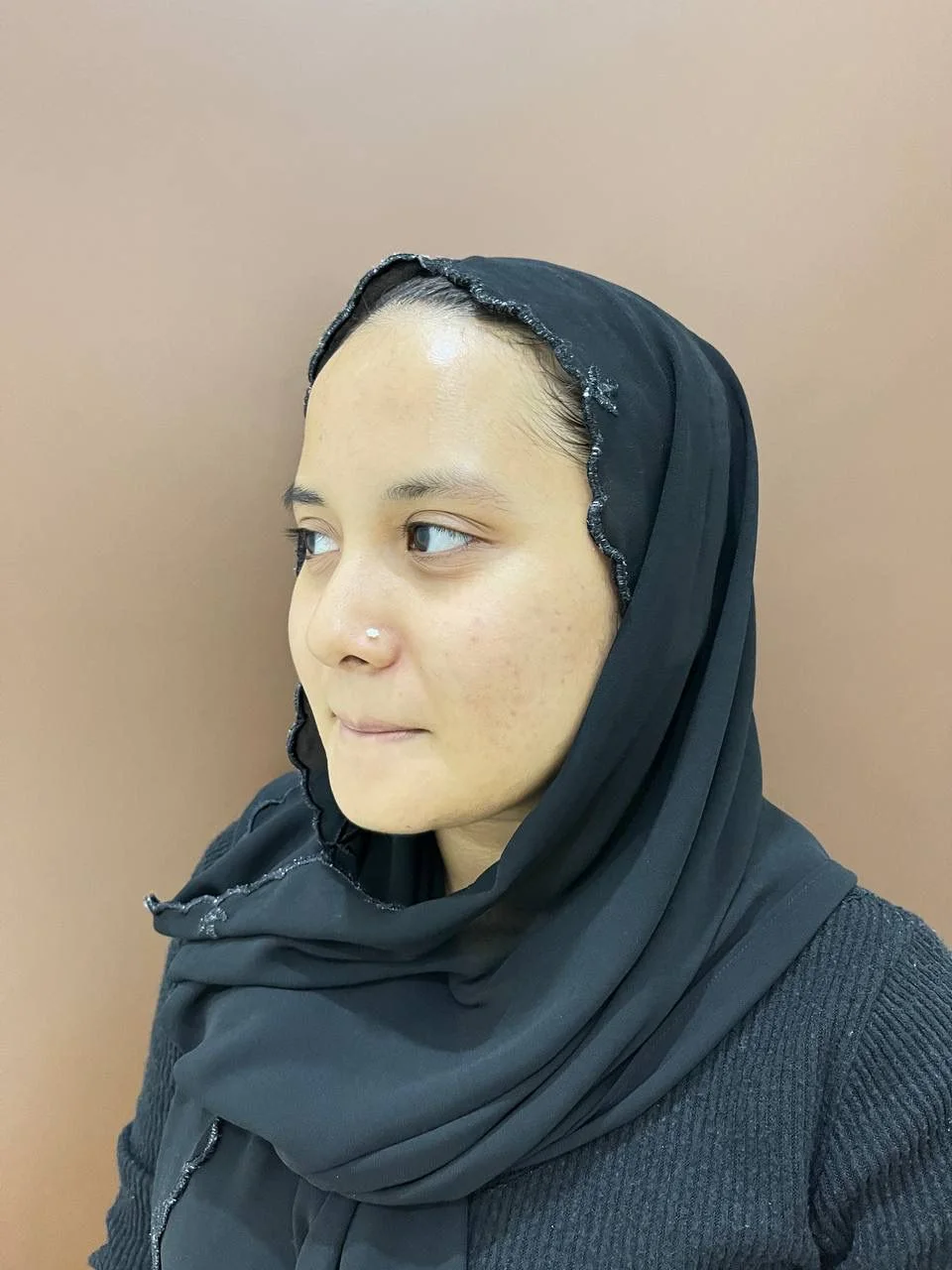 Acne and acne scar side-view progress photo at Majestic Medispa